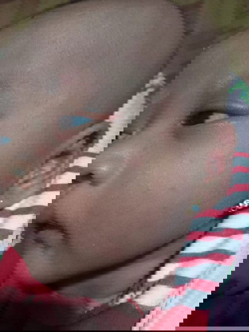 Beruntusan nggak sembuh2