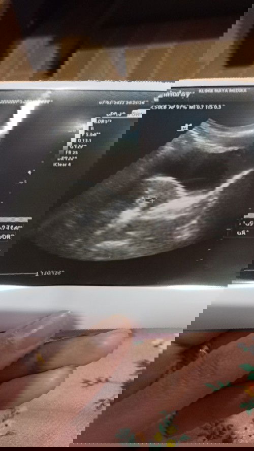 Tp negatif tetapi hamil