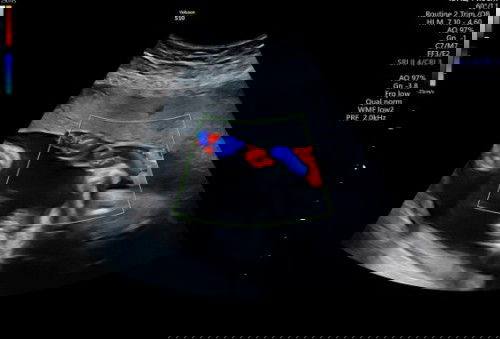 Terlilit pusat dan sungsang
