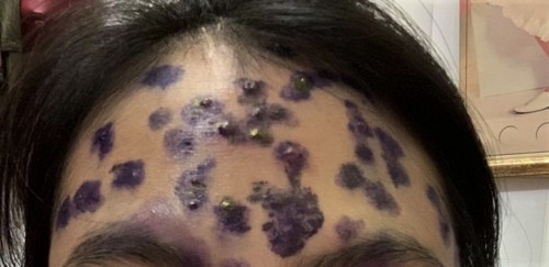 Cách chữa thủy đậu nhanh cho bà bầu