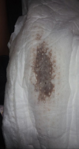 implementation bleeding or period???