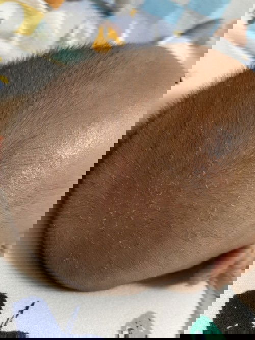 หัวแห้งและลอก