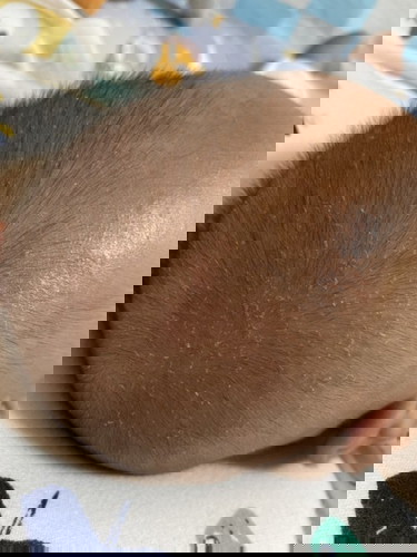 หัวแห้งและลอก