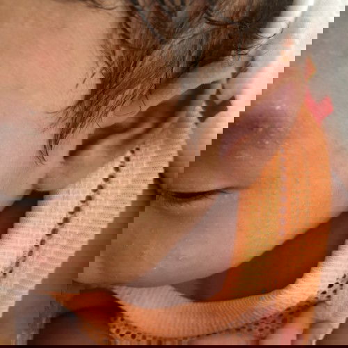 ผื่นขึ้นหน้า เหมือนน้องจะคันด้วย