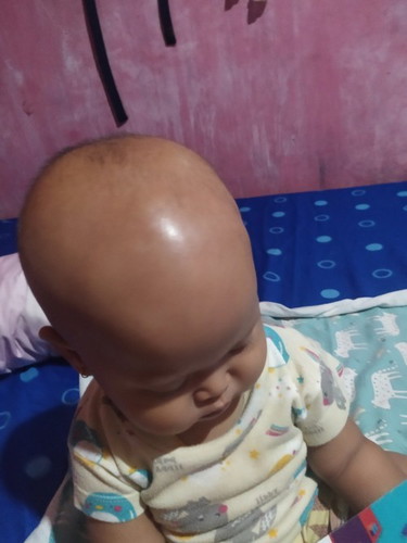 Ubun ubun cembung apakah bahaya?
