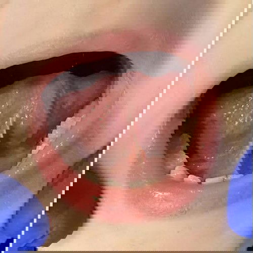 Semi-tongue tied