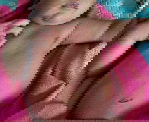 merah" n bentol" pada tubuh bayi 14hari ..