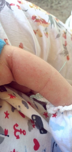 Help po cno nkaranas ng ganito sa baby nila at ano gamot