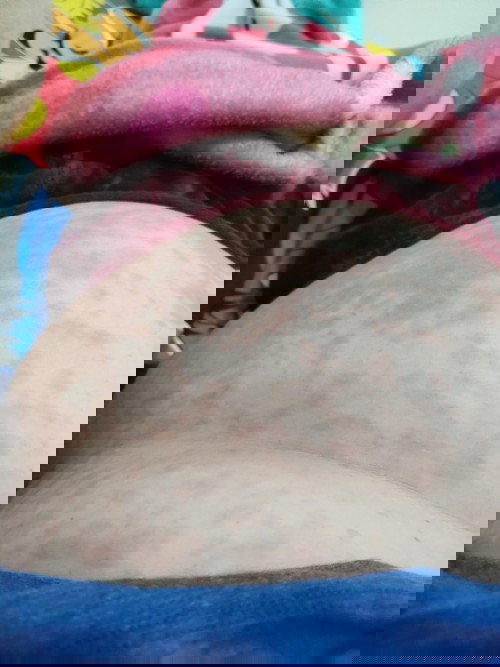 ผื่นขึ้นทั้งตัว