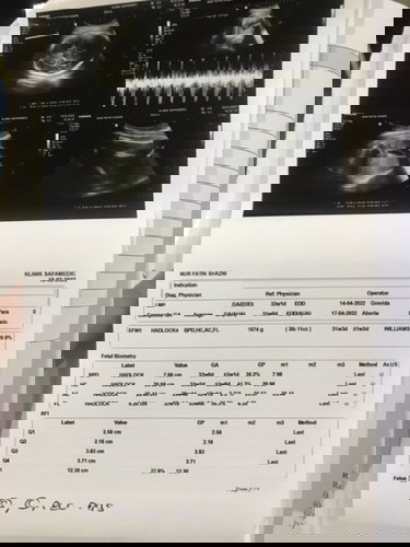 Size perut bayi dalam kandungan kecil