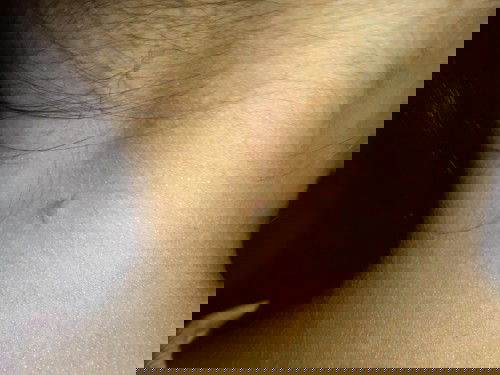 Kulit anak berlubang seperti bekas ditindik