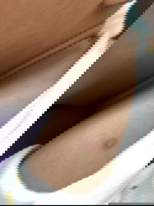 แผลปลูกฝี