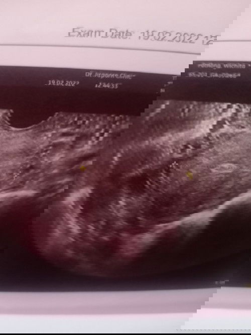 ท้อง9weekตรวจอัลตร้าซาวด์ไม่เจอน้องเลยค่ะ