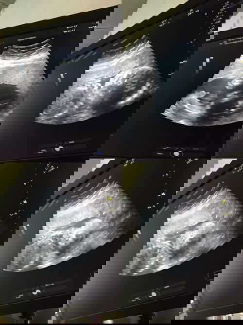 ซาวด์4ครั้งเป็นลูกสาว4ครั้ง พอซาวด์ครั้งที่5สภาพนี้เลยค่ะ5555555