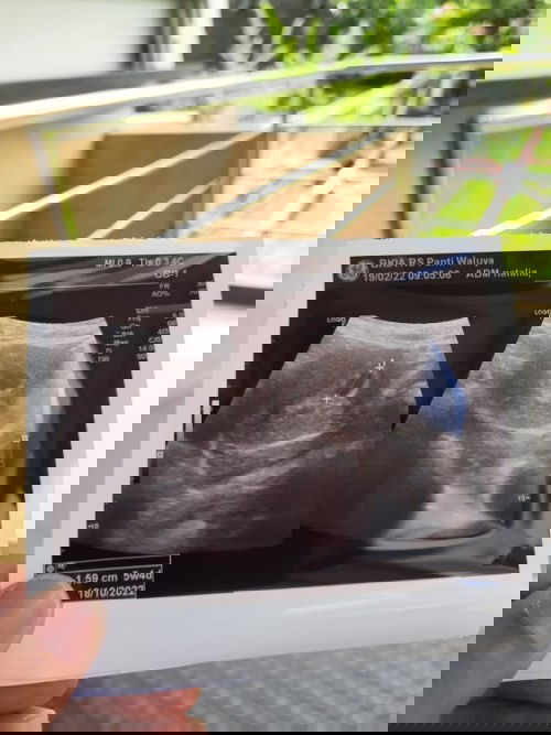 Kapan janin terlihat?