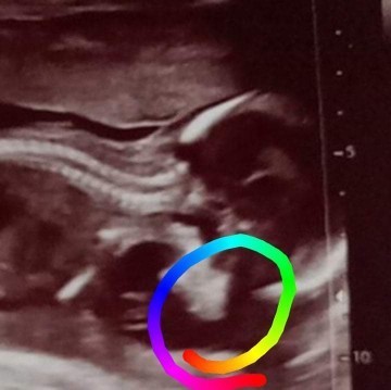17Week ตรงนี้ใช่สันจมูกน้องมั้ยคะ
หรือต้องรอให้อายุครรภ์เยอะกว่านี้ก่อนถึงจะดูออก