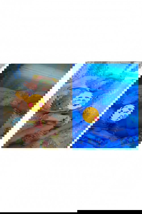 Lahir prematur 31 w , kembar dgn TTTS