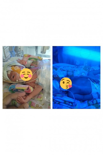 Lahir prematur 31 w , kembar dgn TTTS