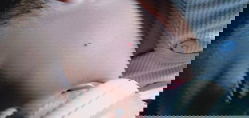 Bekas di gigit nyamuk