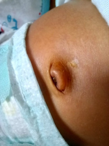 Normal lang po ba ang pusod ng baby ko 1 month na po sya pag umiiri po sya bumubuka. Thank you po.