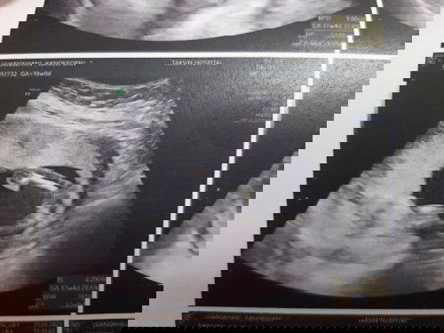 18 Week ซาวด์