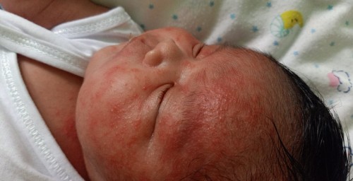 Baby rashes