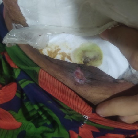 cs incision