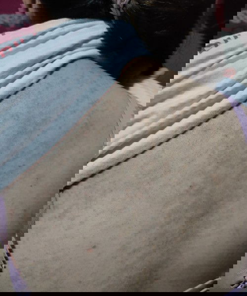 Skin Rashes, Skin disease