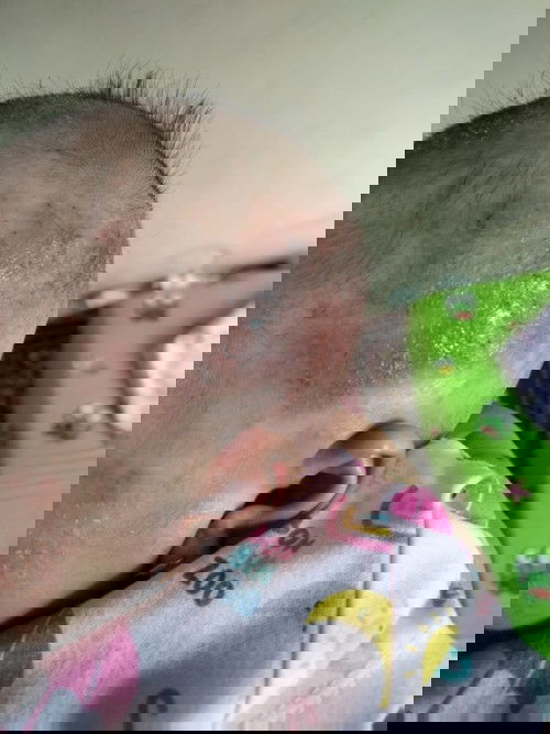 Kulit kepala bayi ku pada merah-merah dan berkerak