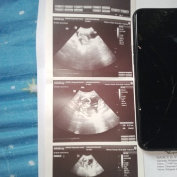 Hi first time mommy here. Sino po may alam sa inyo basahin ung result bg pelvic examination? Pahelp.