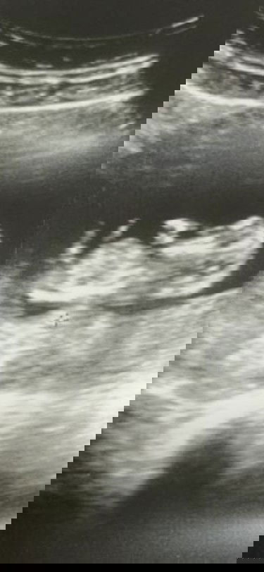 3 months buat ultrasound gender apa😀 curious