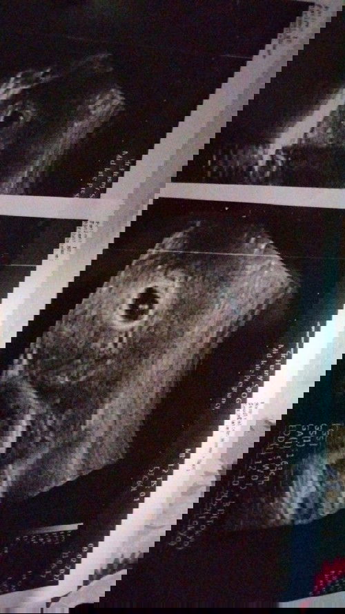 Pendarahan hamil muda