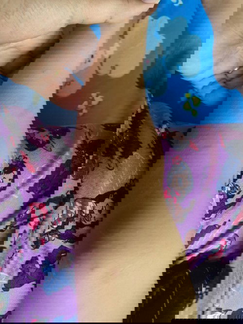 Gamot para sa Rashes