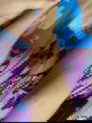 Gamot para sa Rashes