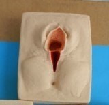 คลอดลูกแผลฉีกเกือบถึงรูทวารแล้วไหมไม่ละลายใครเคยมีประสบการณ์ย้างคะ