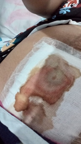 CS wound concern