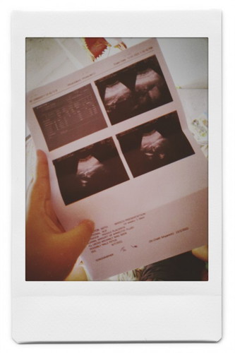 แน่นท้อง นอนไม่ได้