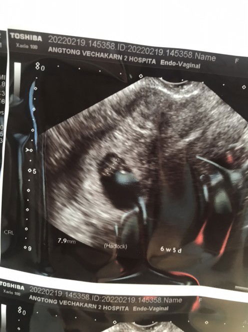 เห็นหัวใจลูกเต้นดีใจมากๆเลยค่ะ แม่ๆเห็นหัวใจลูกเต้นกี่วีคคะ?