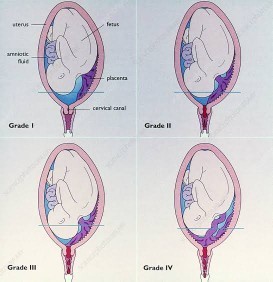 Low Lying Placenta