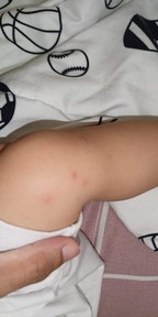 SKIN RASHES