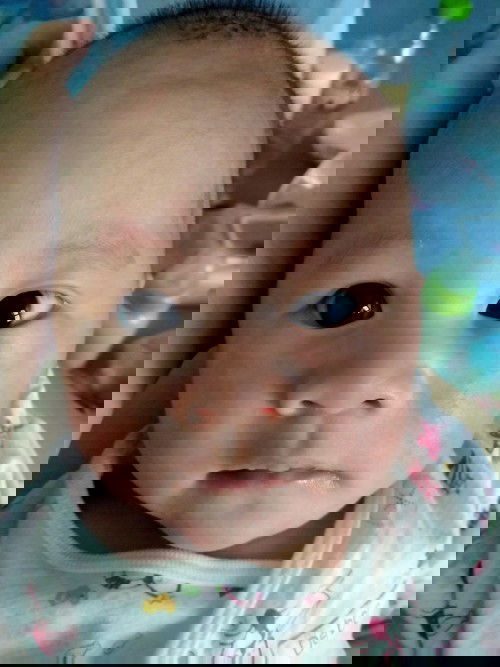 ผื่นแดงผิวสากๆ ที่แก้ม