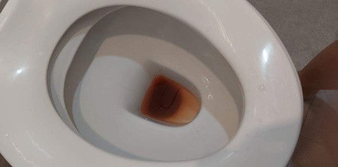 ตั้งครรภ์ 35วีค