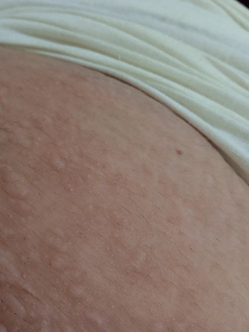 Gatal gatal pasca melahirkan normal