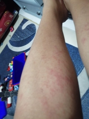 Skin allergy