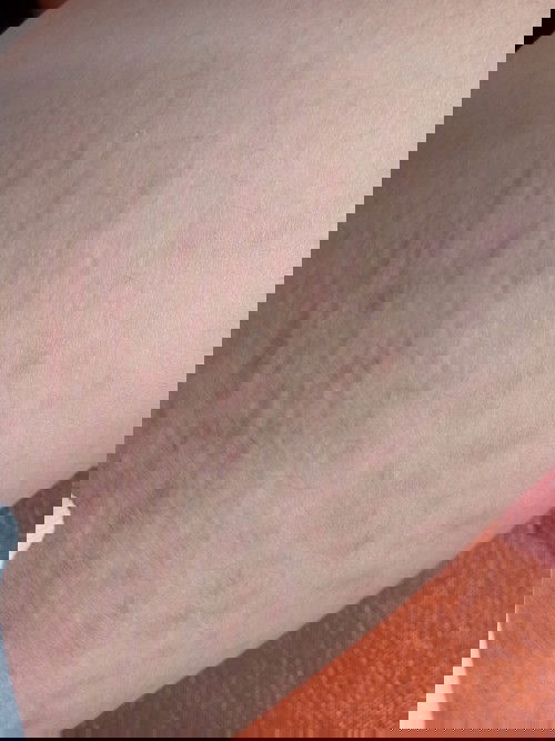 รอยแตกลายหลังคลอดใช้อะไรถึงจะหายคะใช้ครีมมาหลายตัวไม่หายเลยค่ะเครียดมากก