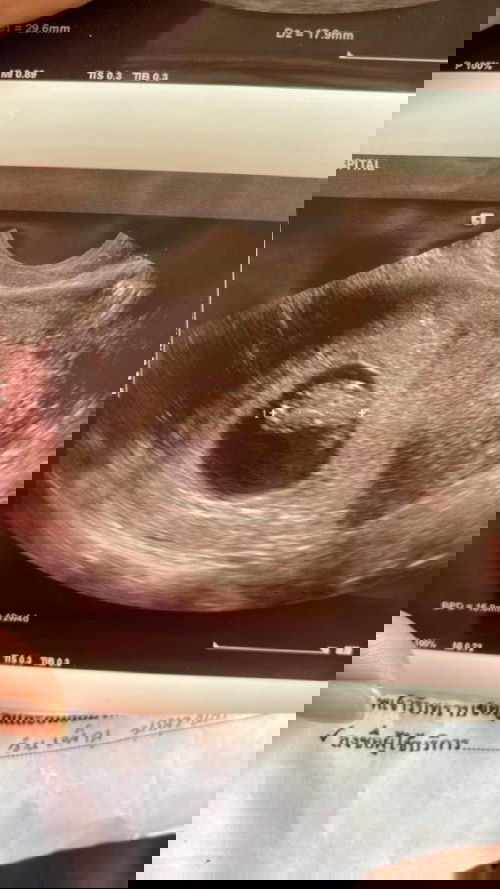 แม่ๆบ้านไหนเป็นแบบนี้บ้างคะ พอดีว่าไปซาวมาแล้วอายุครรภ์ปกติแค่8W แต่ในใบซาวขึ้น12W หมายความว่าไงคะ