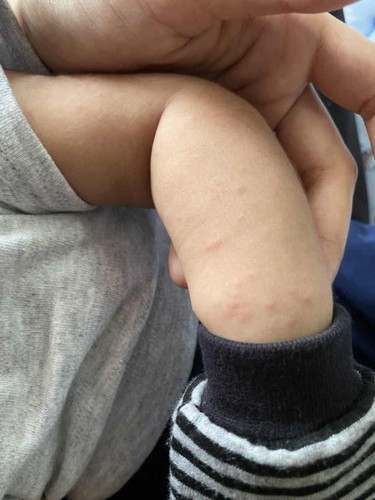 Baby skin condition