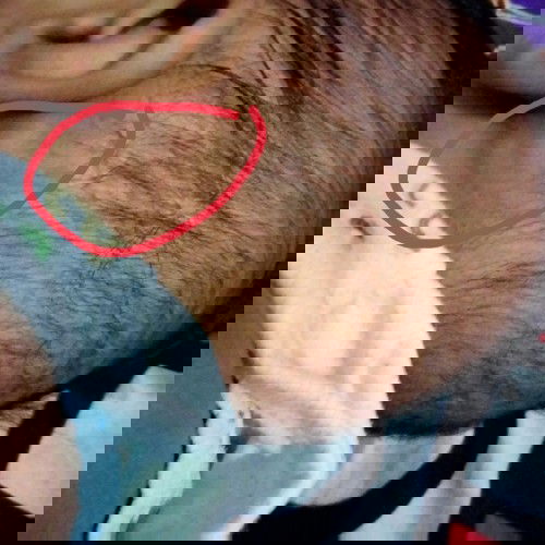 Benjolan di belakang telinga