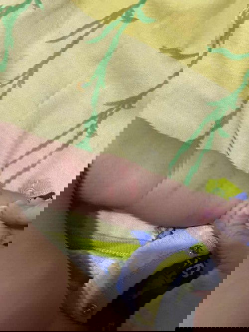 Bentol penyebabnya apa?