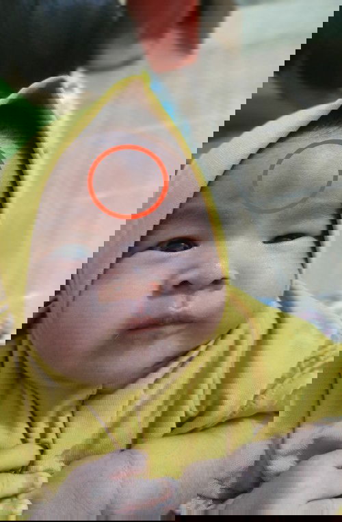 Benjolan di tengah dahi/kening sejak lahir